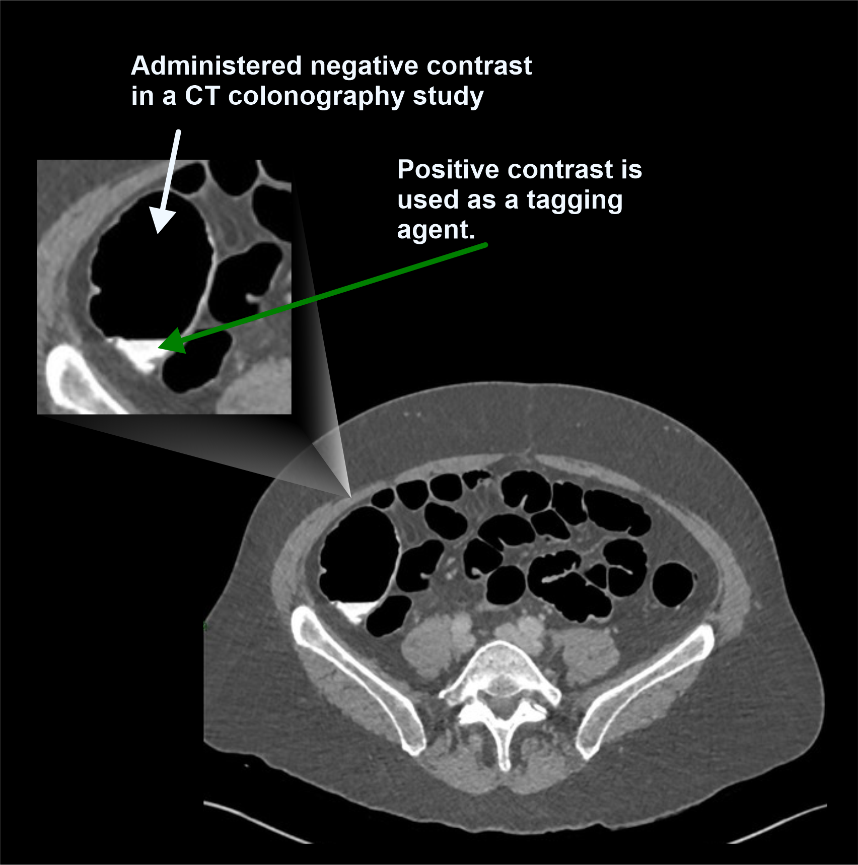 Demonstrates negative contrast filled bowels in a CT colonography scan.