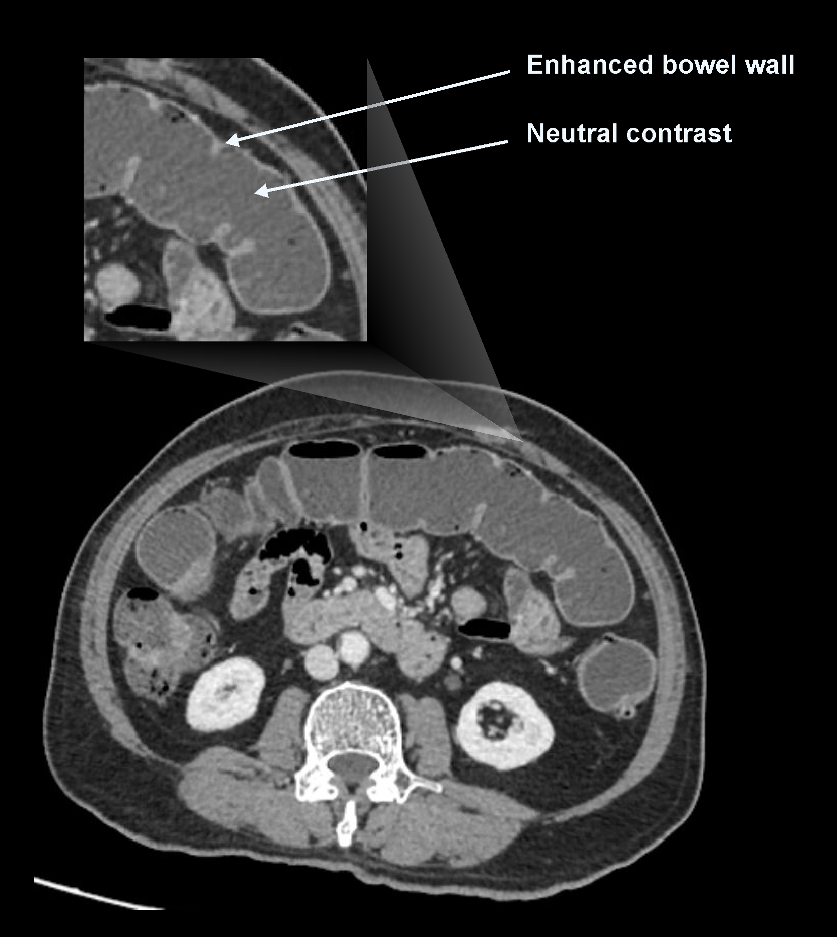 Demonstrates adequate contrast between bowel wall and neutral contrast media in a CT multiphase abdomen.
