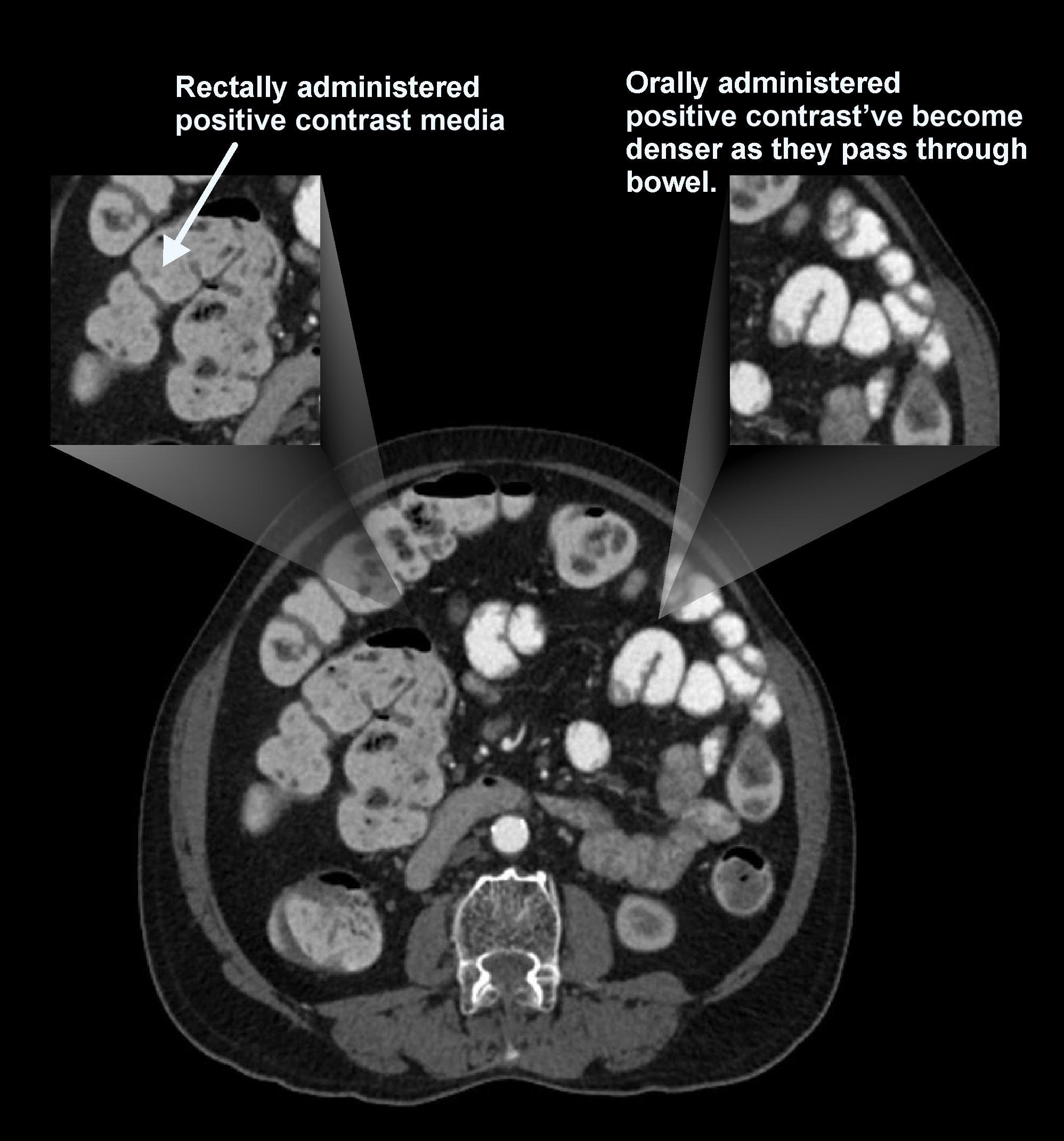 Demonstrates positive contrast filled bowels in a CT triple phase abdomen scan.
