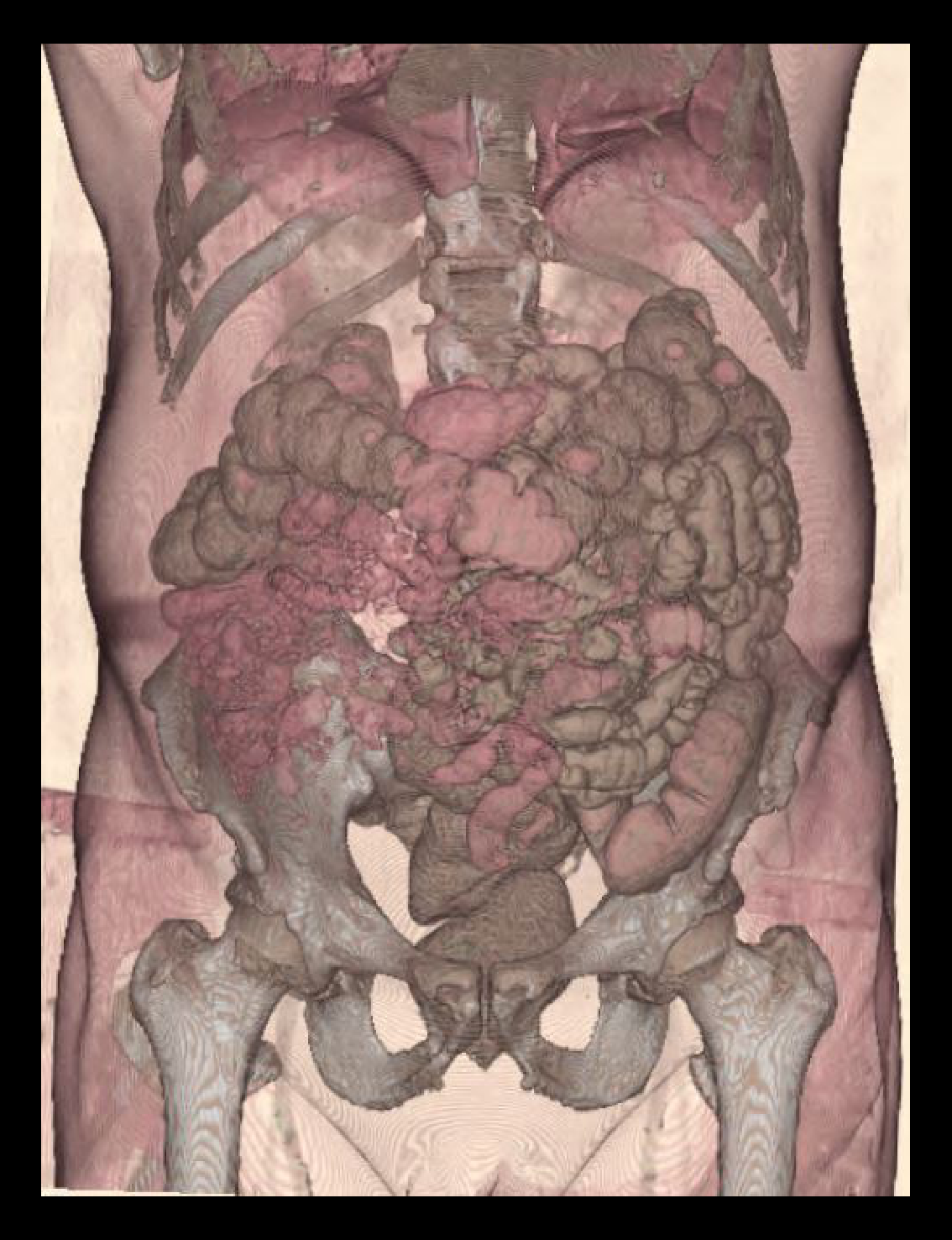 Layered surface rendered images of a CECT abdomen