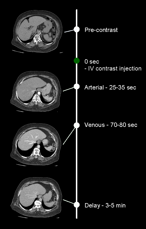 Demonstrates phases in a CT four phase abdomen