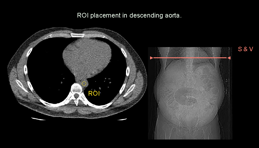 Demonstrates ROI placement for bolus tracking in a CT CECT liver scan.