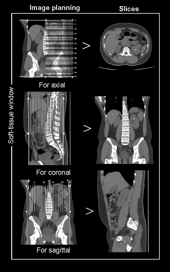 Demonstrates multi planar reformation (MPR) for non-contrast abdomen.