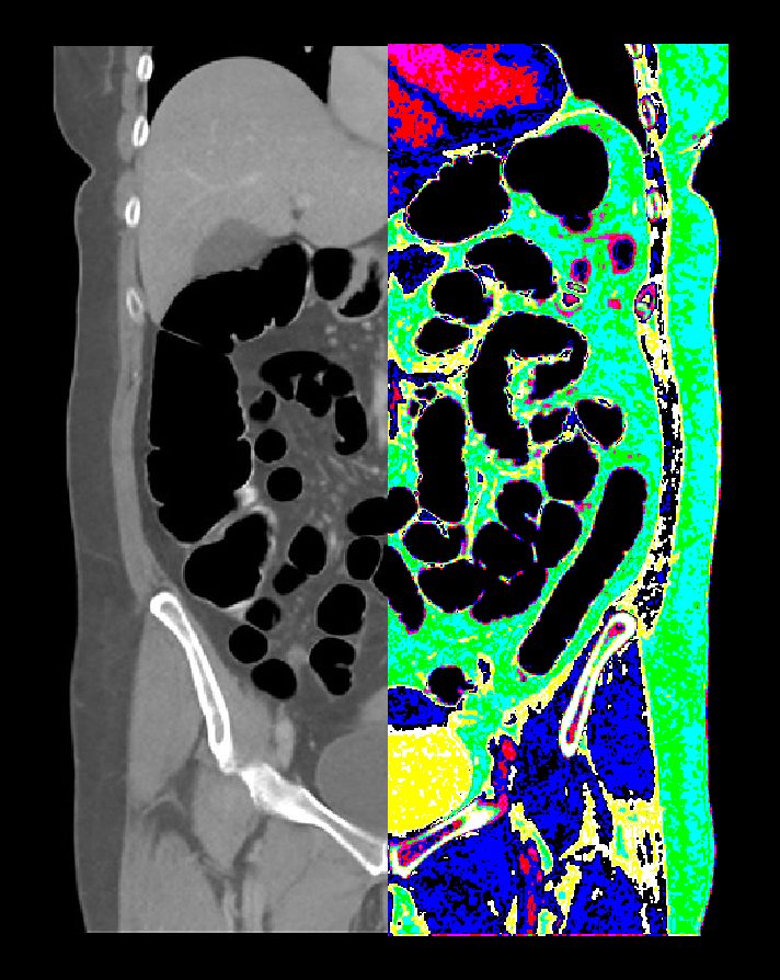 Altered images of a NCCT abdomen.