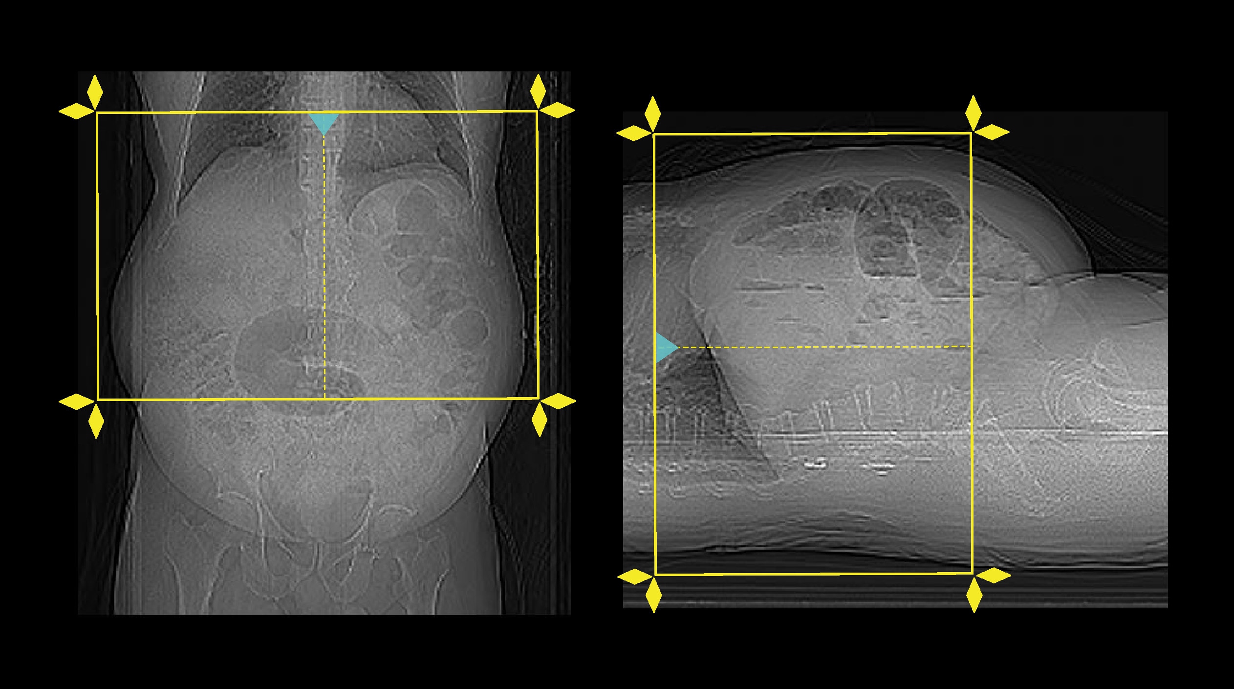 Demonstrates scan slab planning for NCCT abdomen.