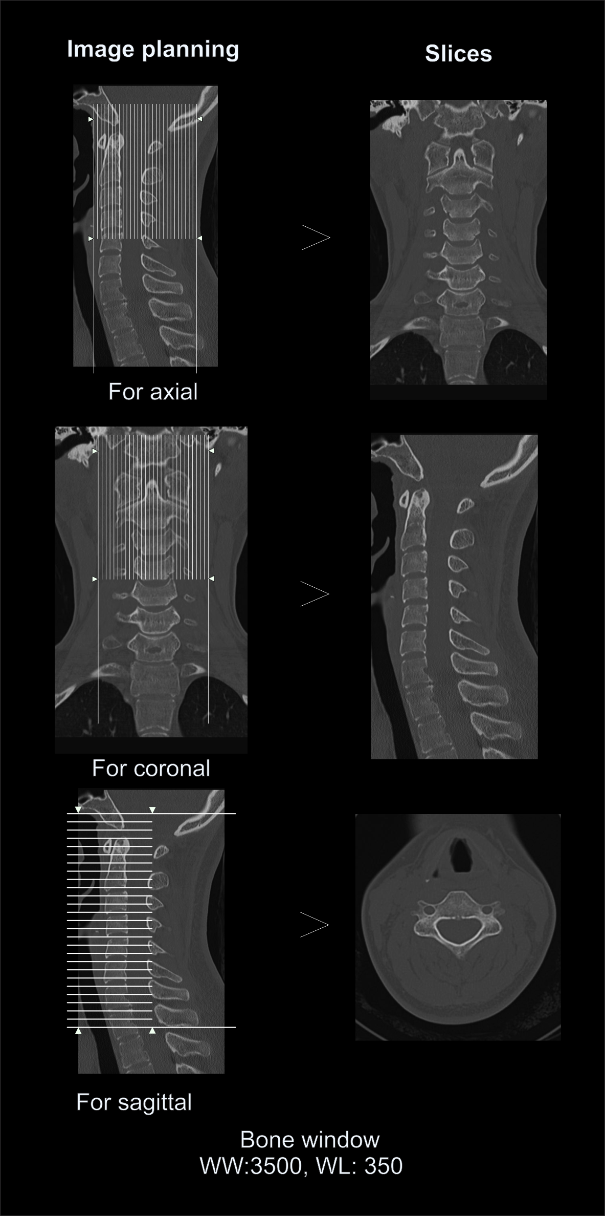 Demonstrates multi planar reformation (MPR) for CT Cervical spine.