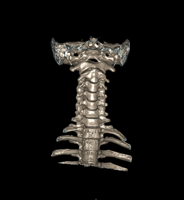 3D Surface rendered image of cervical spine - taken from a CT cervical spine scan.
