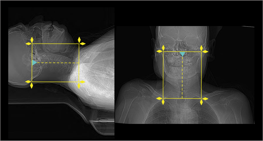 Demonstrates scan planning for CT C spine.