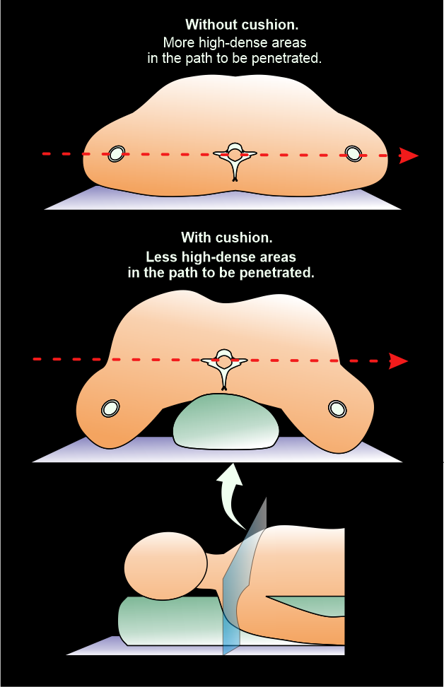 Illustration demonstrates a methodology to reduce streak artifacts from neck region by placing a cushion under spine.