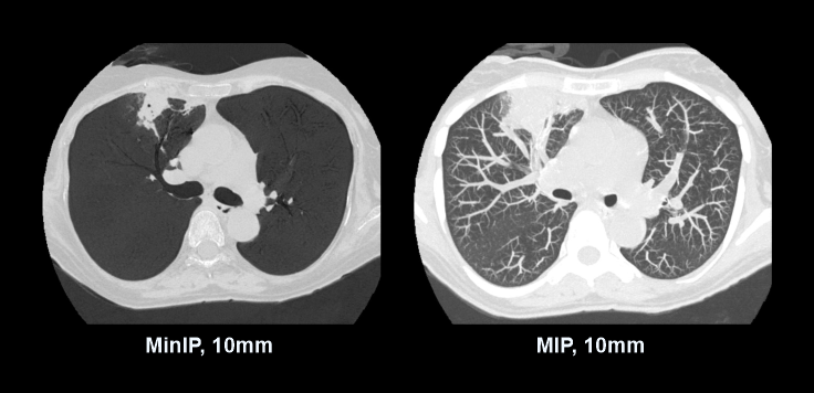 Demonstrates minimum intensity projection (MinIP) and maximum intensity projection (MIP) images of a NCCT chest scan. These images are useful to diagnose air trapping and emphysema.