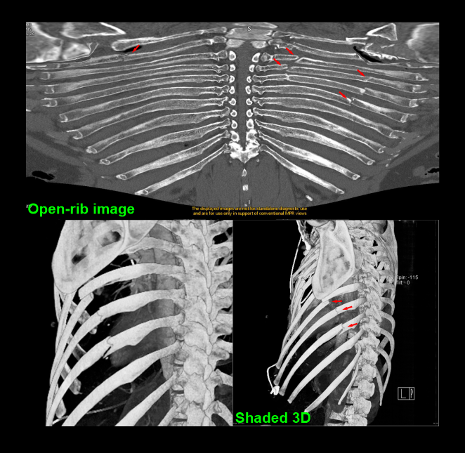 Open-rib and surface shaded images (bone window) showing fractured ribs.