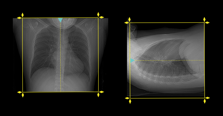 Demonstrates scan slab planning for CT non-contrast chest scan.