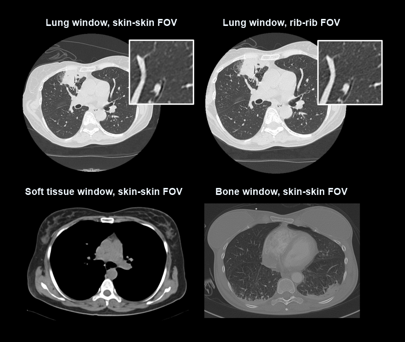 Demonstrates that the spatial resolution of lung tissue can be increased by limiting field of view (FOV) rib to rib. However, FOV of bone and soft-tissue windows need to be skin to skin for NCCT chest.