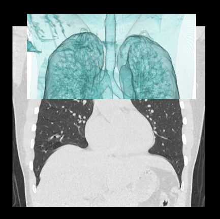Altered images of NCCT chest scan.