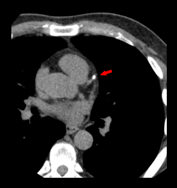 Axial image of a CT coronary calcium scoring scan shows a speck of calcium in the left anterior descending (LAD) artery.