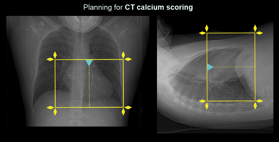 Demonstrates scan slab planning for CT coronary calcium scoring scan.