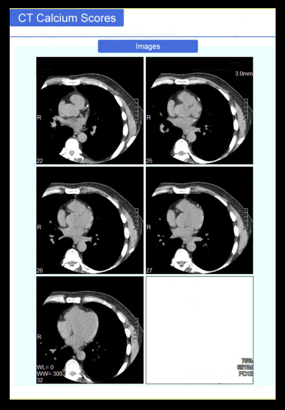 Demonstrates axial images of a CT coronary calcium score scan.