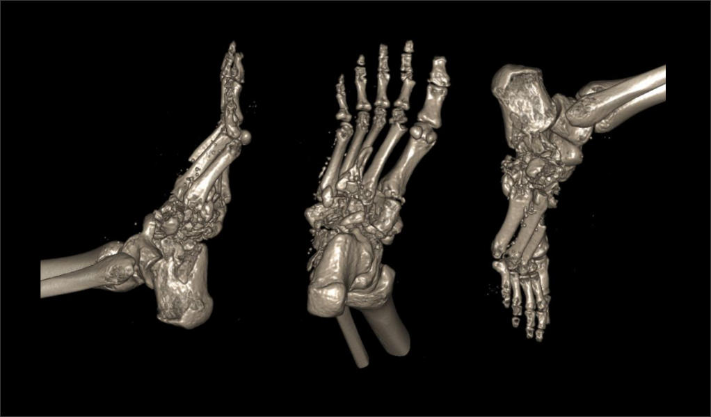 3D surface shaded display images of CT foot scan. Images are created using raw data of a CT foot scan.