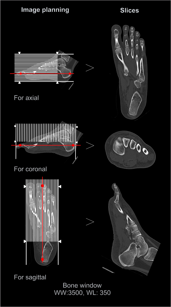 Multiplanar reconstruction (MPR) for CT foot scan is shown here. All images are in bone window.