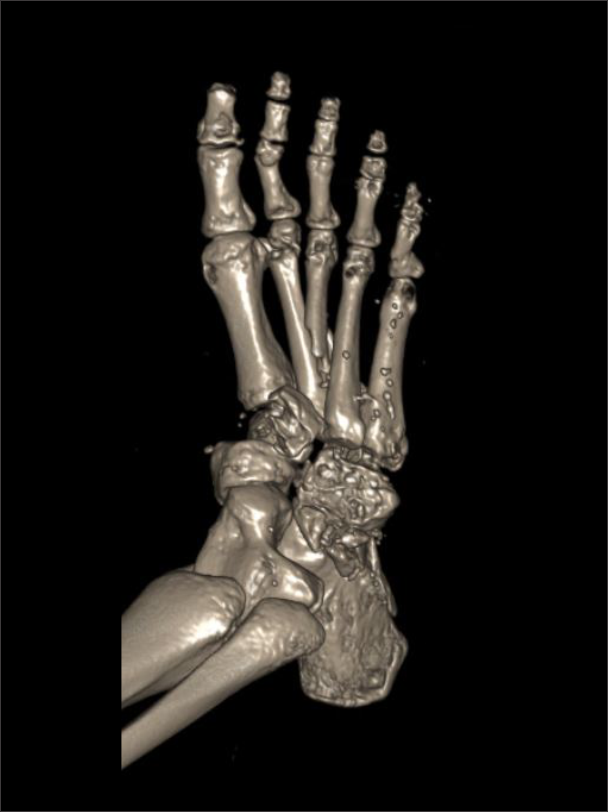 Surface shaded display (3D) image of the foot. Image is reconstructed from data of CT foot scan.