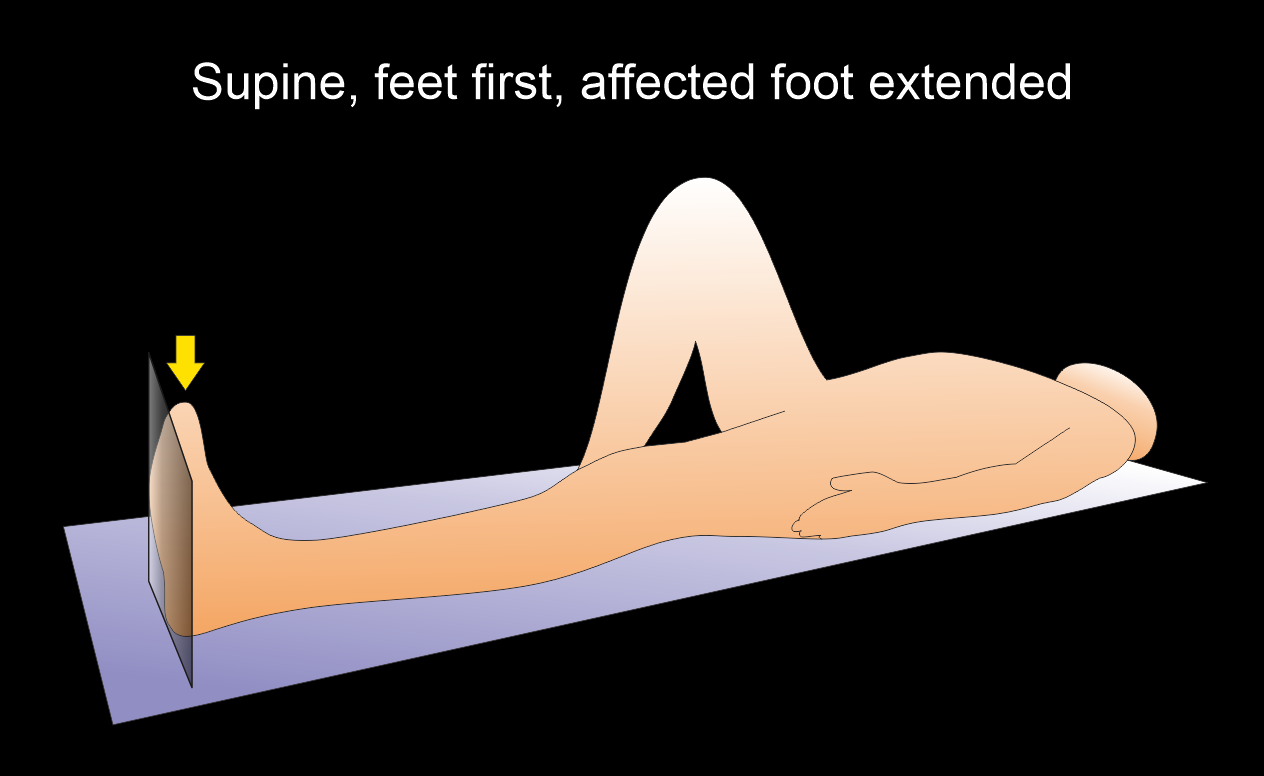 Demonstrates patient positioning for CT foot scan. Limb with the affected foot is extended.