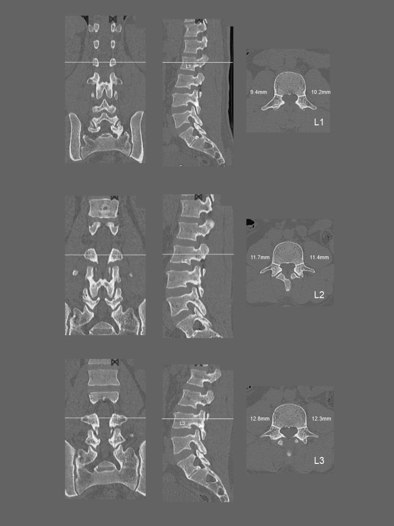 Pedicle measurement in CT whole spine scan.