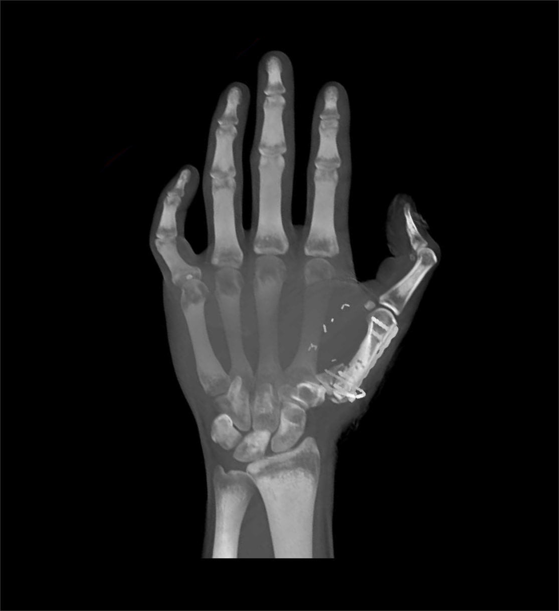 Maximum intensity projection images of a CT hand scan.