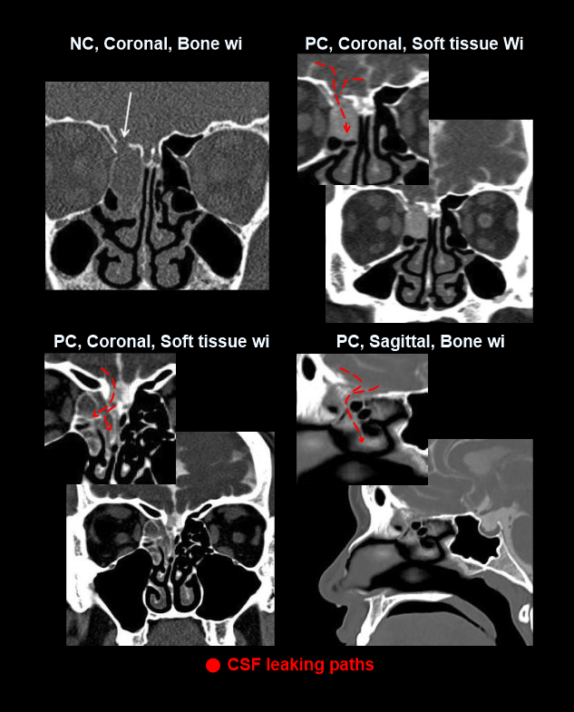 Images of a CT cisternography demonstrate abnormal CSF flow paths of a patients sinuses.