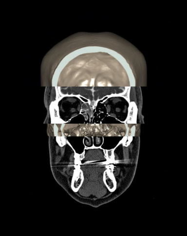 Combination of images from a CT cisternography study of the head