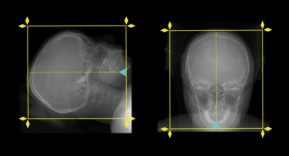 Demonstrates scan slab planning for CT cisternography study.