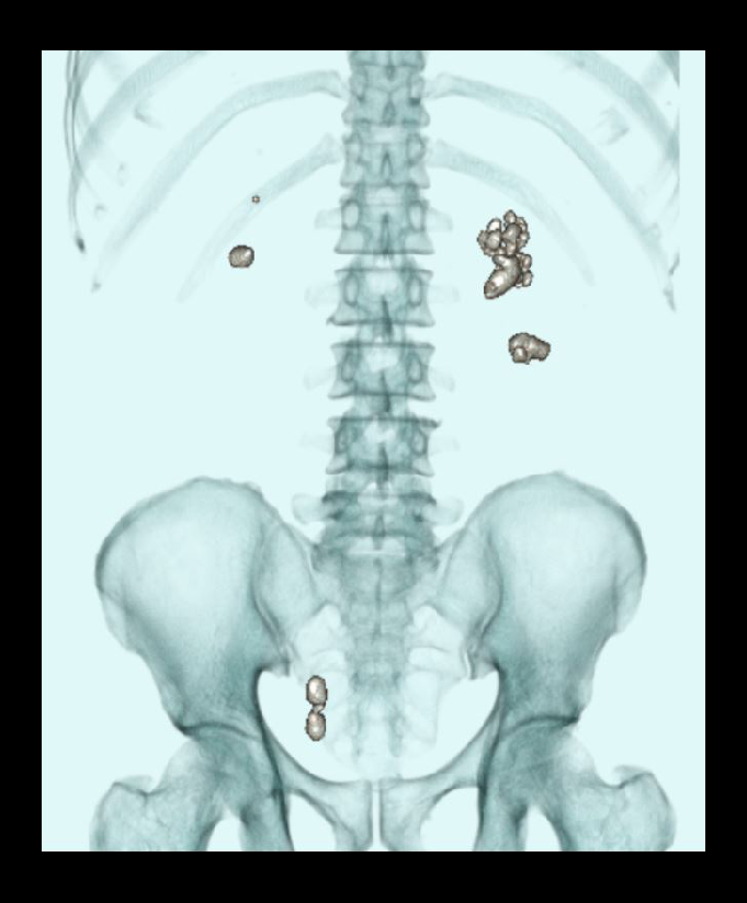 Layered 3D surface rendered images of a NCCT KUB, demonstrating renal stones.