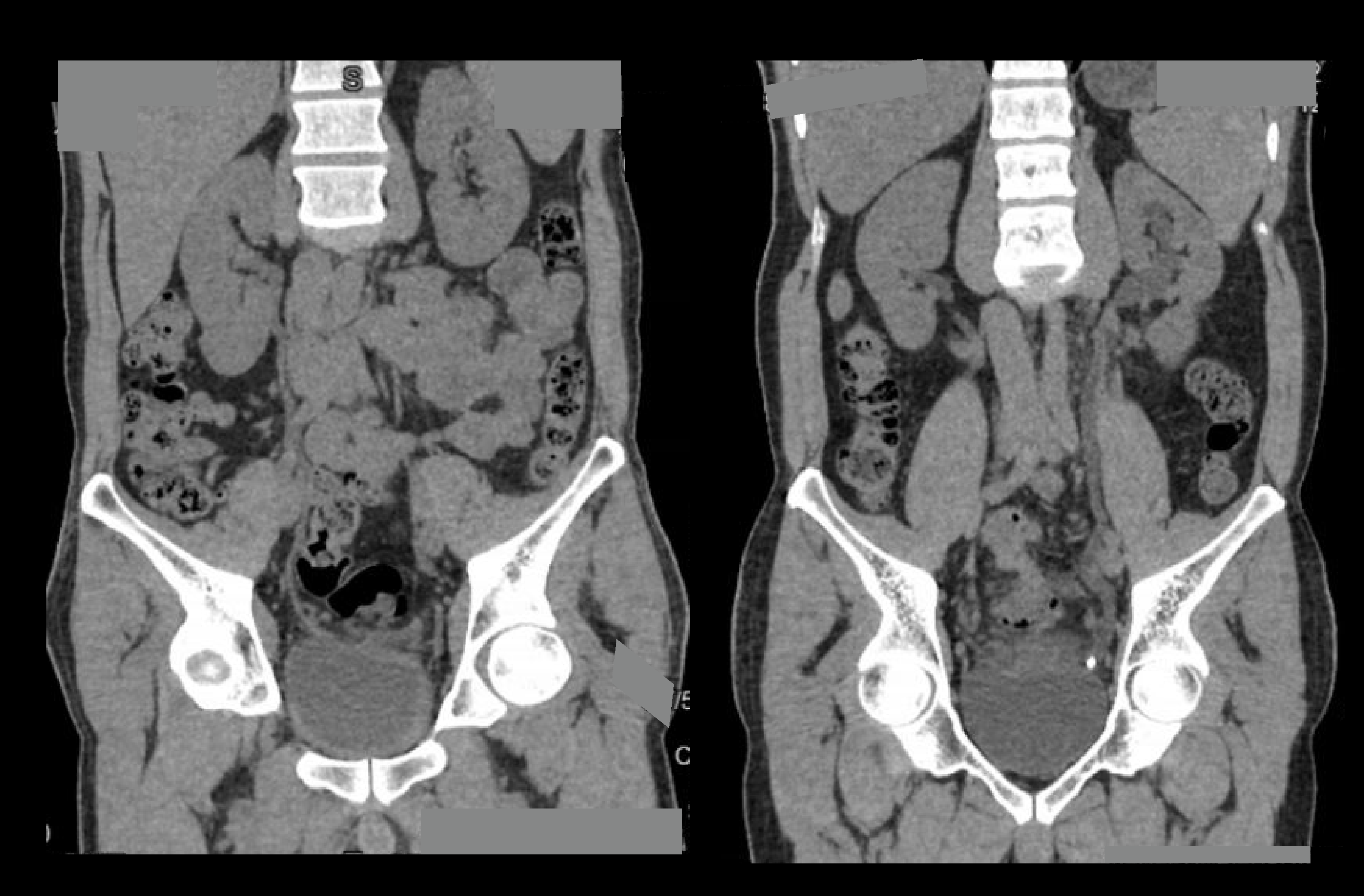 Demonstrates length and density measurements of renal stones detected in a CT non-contrast KUB scan.