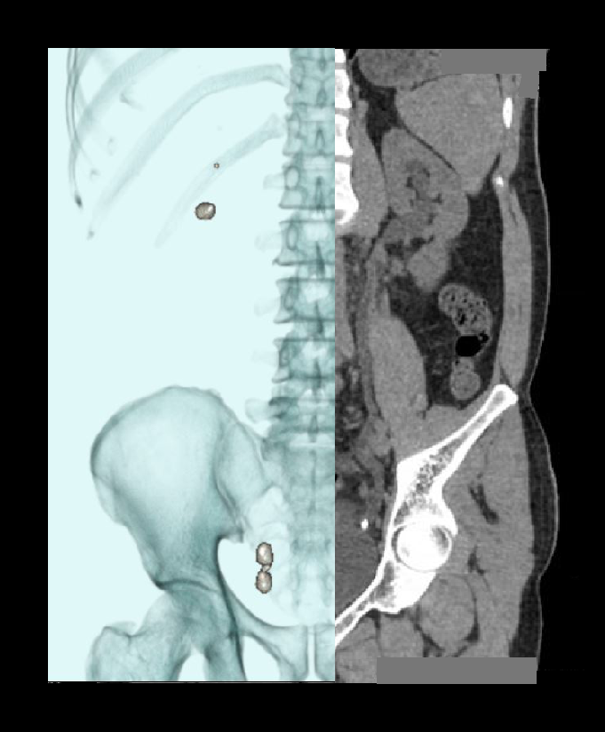 Altered images of a NCCT KUB scan.