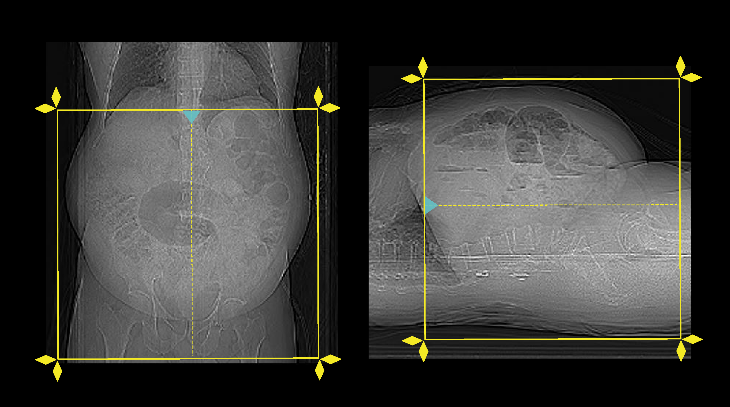 Demonstrates scan slab planning for CT non-contrast KUB scan.