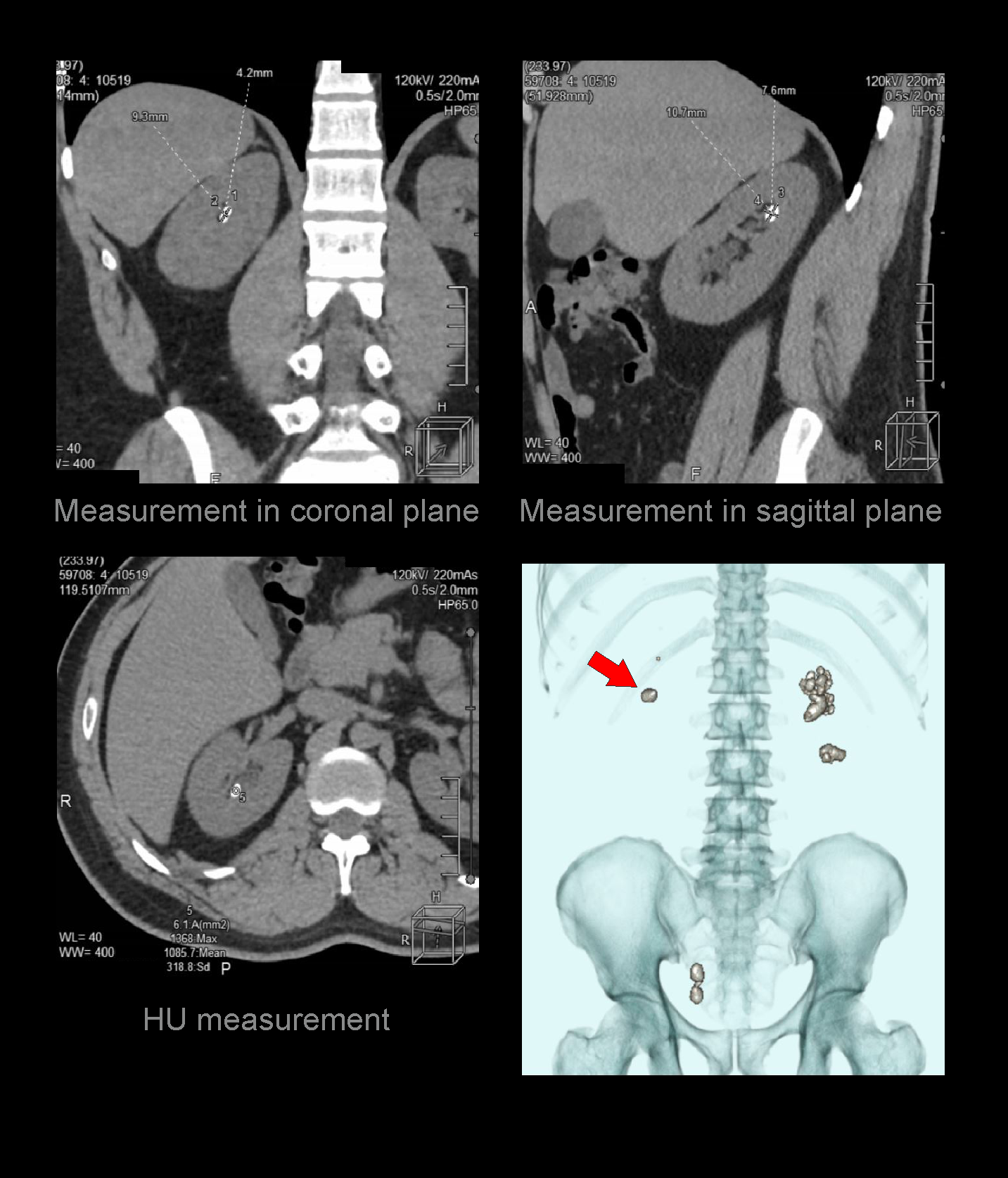 Demonstrates length and density measurements of renal stones detected in a CT non-contrast KUB scan.