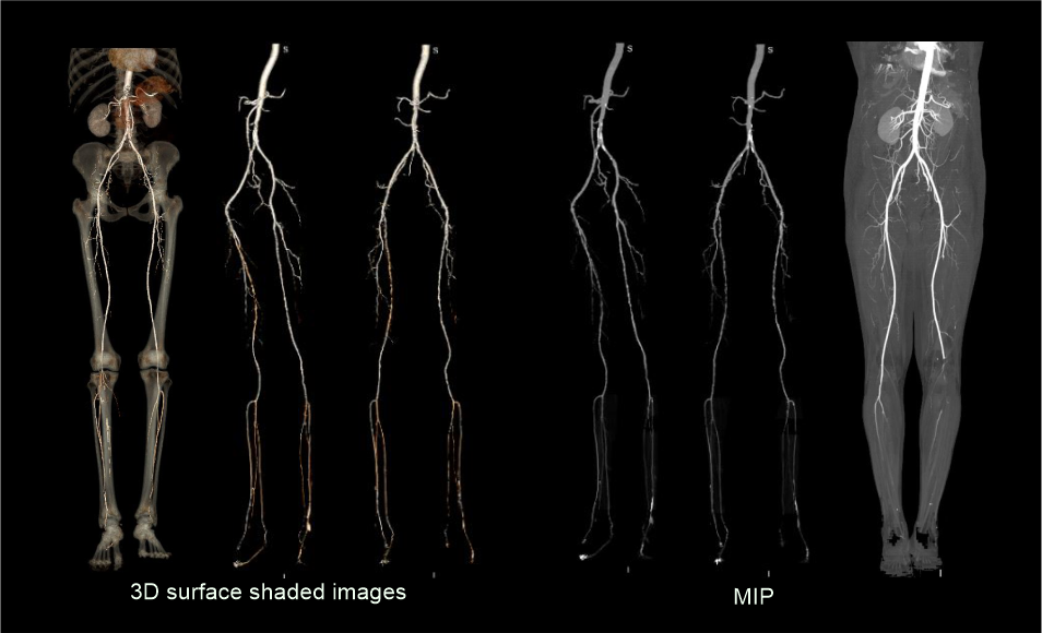 Demonstrates 3D surface shaded and maximum intensity projection (MIP) images of a CT peripheral angiography scan of lower limbs.