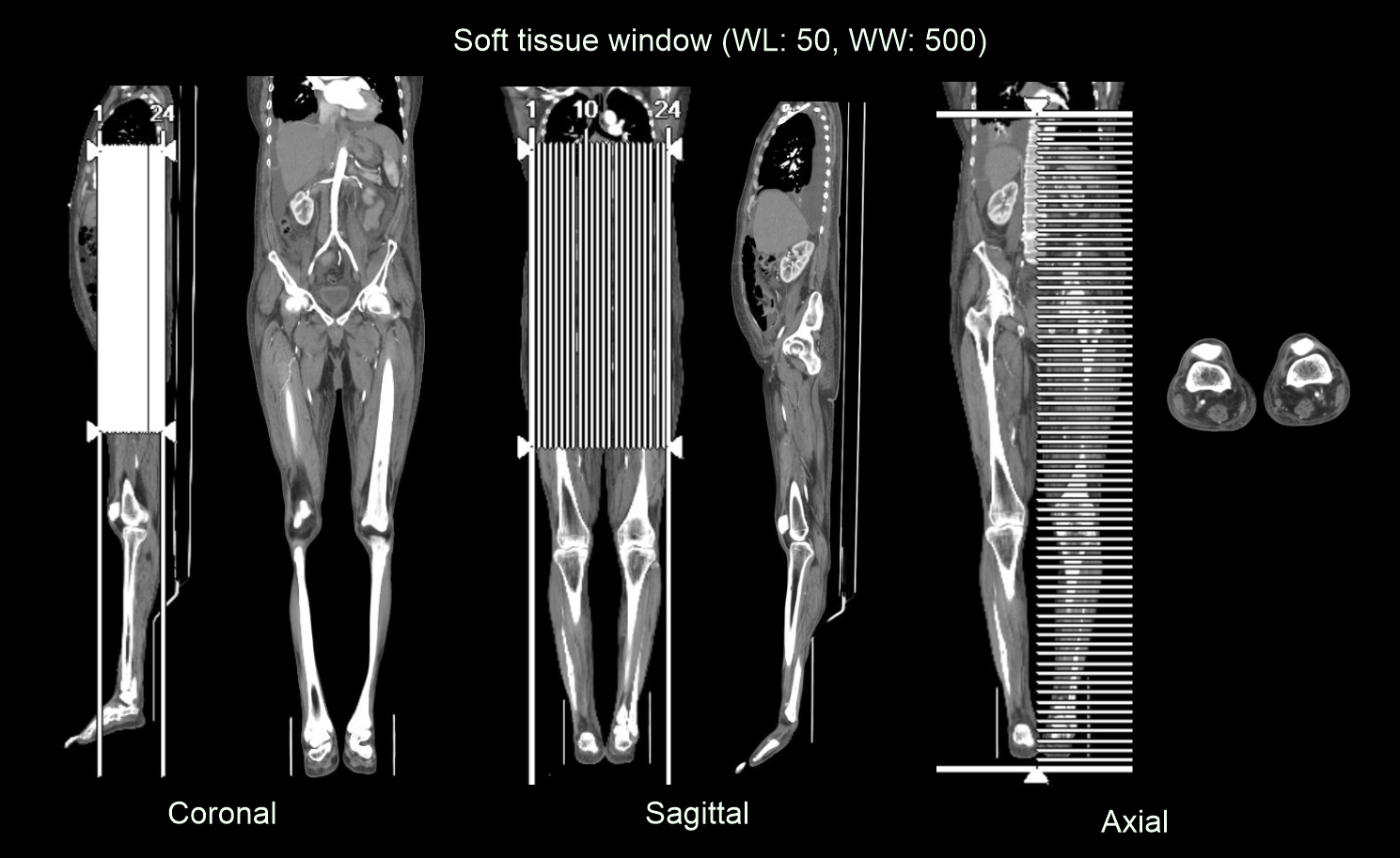 Demonstrates multiplanar reformation (MPR) for CT lower limb angiography.