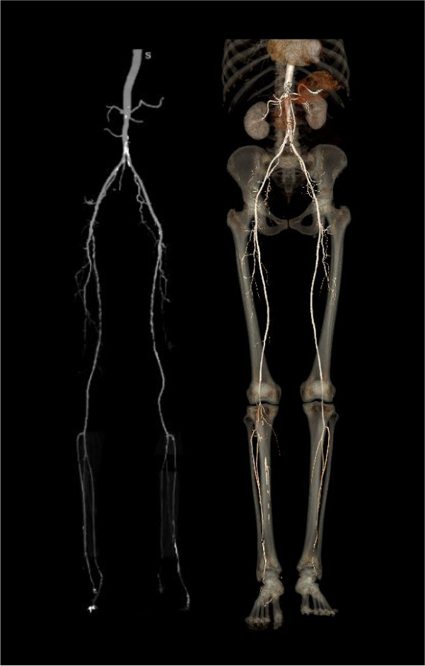 Demonstrates post-processed images of CT lower limb peripheral angiogram. Image on your left - Maximum intensity projection (MIP), and image on your right - surface shaded display 3D.