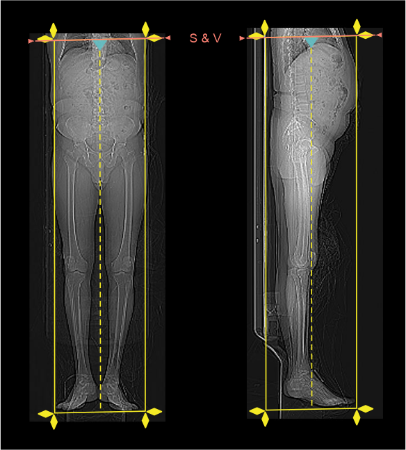 Demonstrates scan slab and bolus track slice planning for CT lower limb peripheral angiography.
