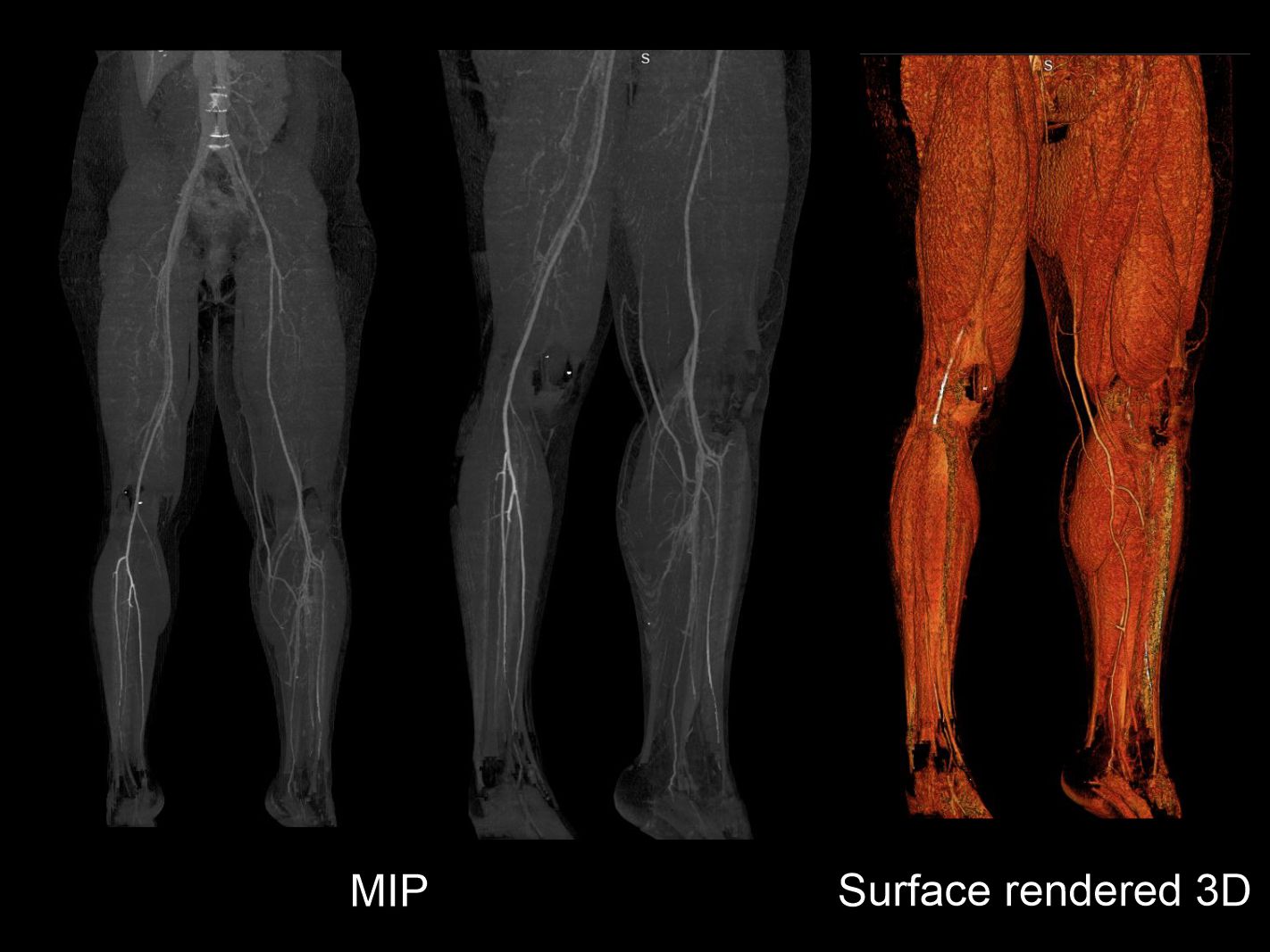 Demonstrates MIP and 3D images of CT Venogram of lower limbs.