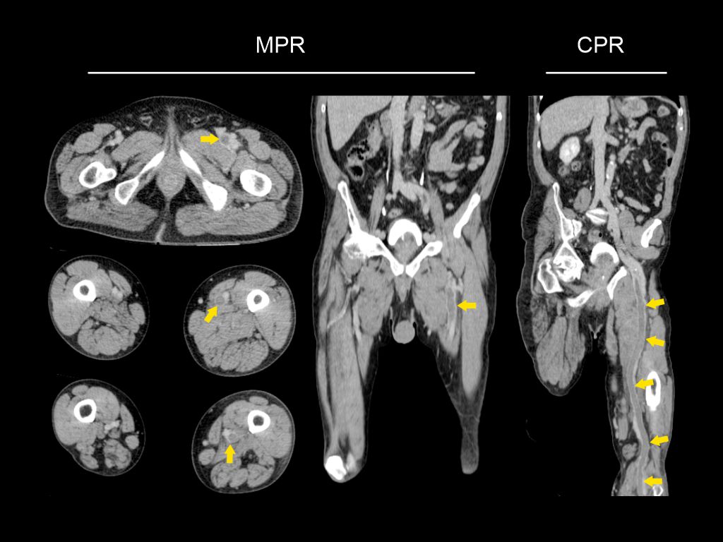 MPR and CPR images of CT venogram of lower limbs.