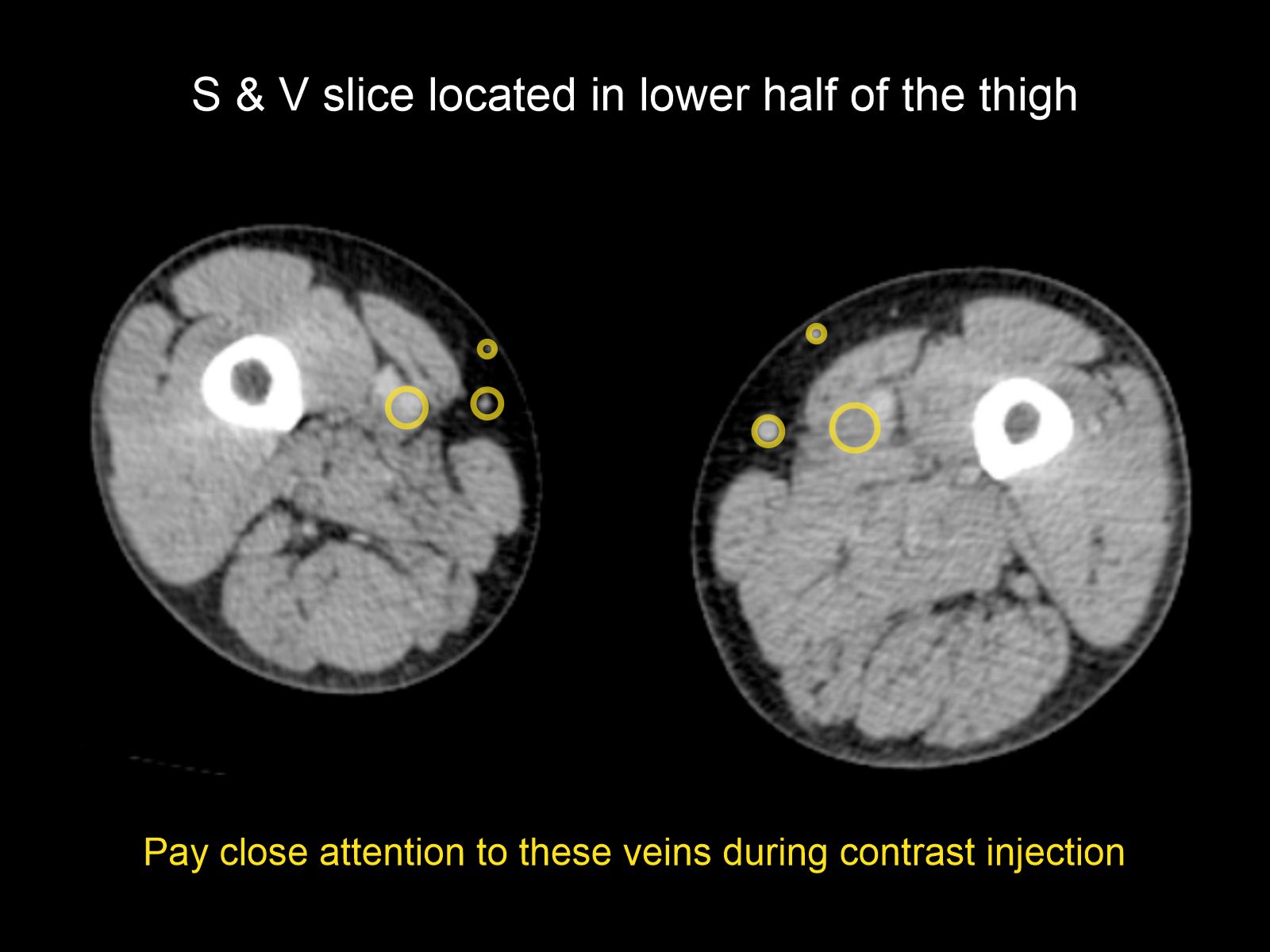 Demonstrates veins in the S & V slice of CT venogram of lower limbs.