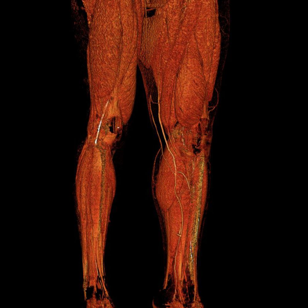 3D Surface shaded display image demonstrating superficial veins of lower limbs, and image is taken from a CTV of lower limbs.