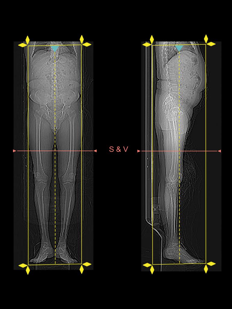 Demonstrates planning for CT Venography of lower limbs.