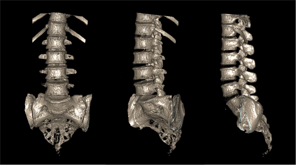 Demonstrates 3D surface shaded display (SSD) image of a CT lumbar sacral spine scan.