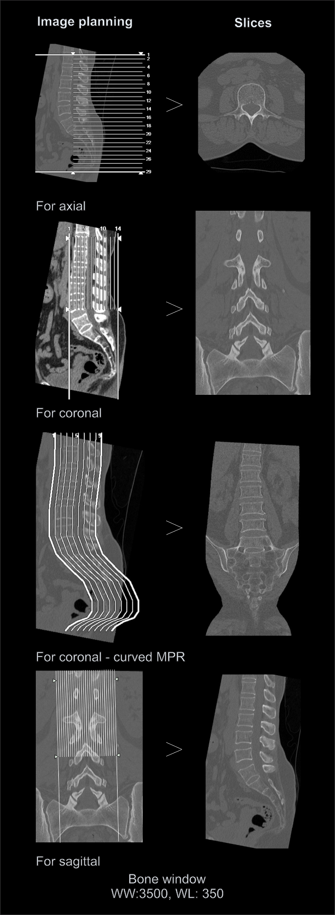 Multi planar reformation (MPR) for CT lumbar scan.