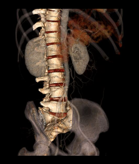 Layered 3D surface shaded images of CT lumbar sacral spine scan.