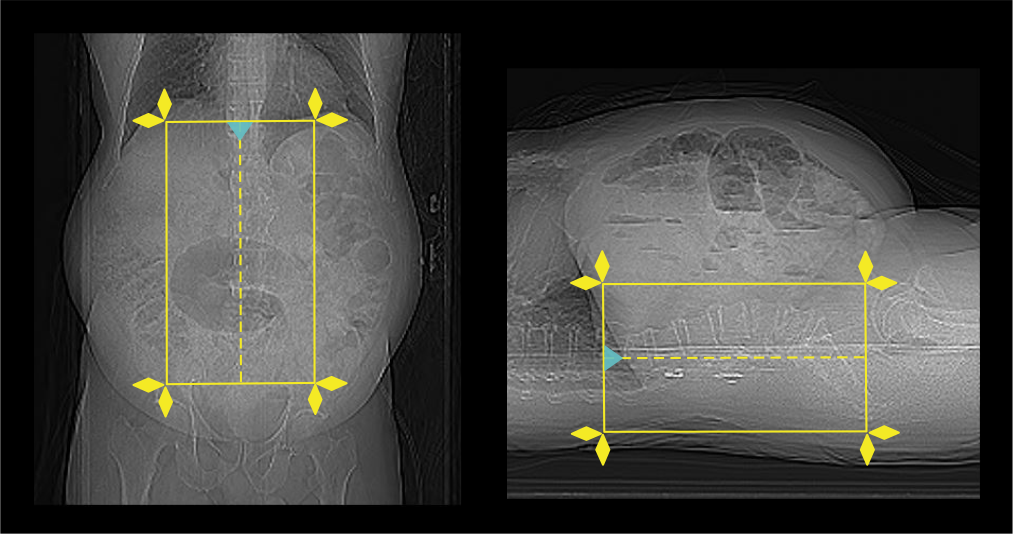 Demonstrates scan slab planning for CT LS spine scan.