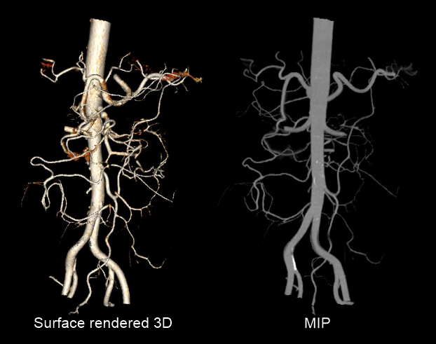 Demonstrates 3D surface rendered and maximum intensity projection (MIP) images of mesenteric arteries. Data from a CT mesenteric angio scan is used to create those images.