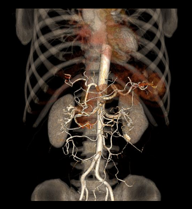 Laired surface rendered image of CT mesenteric angiogram.